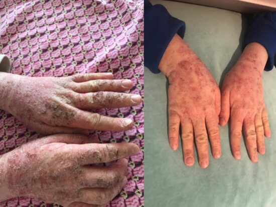 Two images showing severe atopic eczema on the hands of an 11 year old girl, and her much-improved hands after using the X39 patch daily for one month 