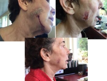 Photos showing the bad surgery scar on the face of Beth's friend which doctors said would take a year bottom photo showing a nearly healed scar after just 21 days of wearing the stem cell patch.